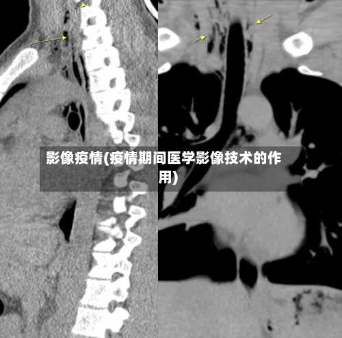 影像疫情(疫情期间医学影像技术的作用)