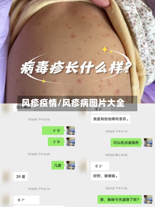 风疹疫情/风疹病图片大全