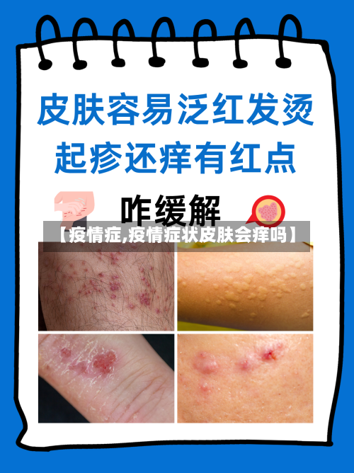 【疫情症,疫情症状皮肤会痒吗】