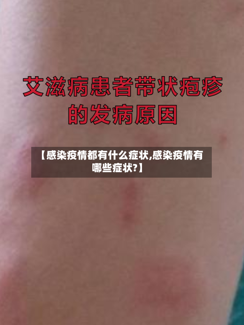 【感染疫情都有什么症状,感染疫情有哪些症状?】