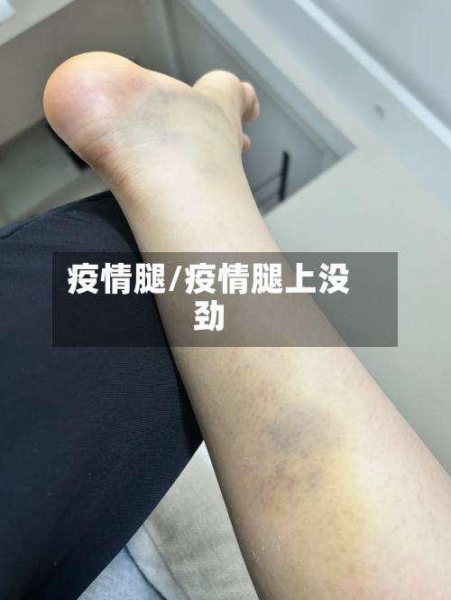 疫情腿/疫情腿上没劲-第2张图片