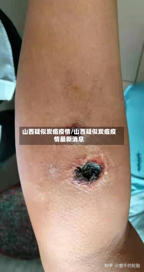 山西疑似炭疽疫情/山西疑似炭疽疫情最新消息