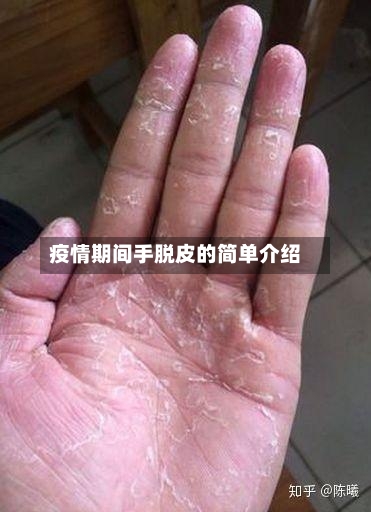 疫情期间手脱皮的简单介绍